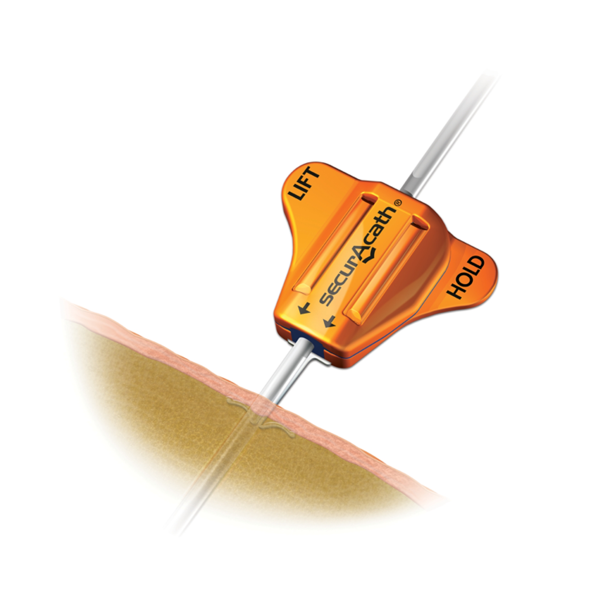  Subcutaneous Engineered Stabilization Device SecurAcath